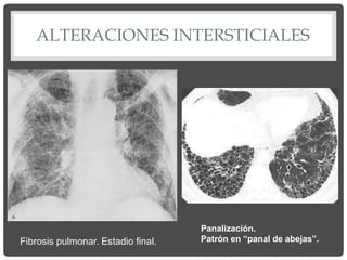 ALTERACIONES INTERSTICIALES
Panalización.
Patrón en “panal de abejas”.
Fibrosis pulmonar. Estadio final.
 