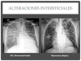 ALTERACIONES INTERSTICIALES
ICC descompensada Neumonía Atípica
 