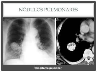 NÓDULOS PULMONARES
Hamartoma pulmonar
 