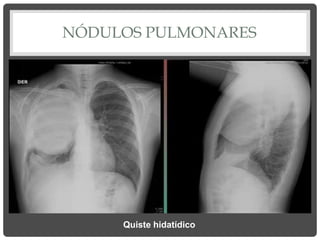 NÓDULOS PULMONARES
Quiste hidatídico
 