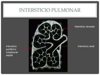 INTERSTICIO PULMONAR
Intersticio axial
Intersticio
periférico
subpleural-
septal
Intersticio alveolar
 
