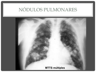 NÓDULOS PULMONARES
MTTS múltiples
 