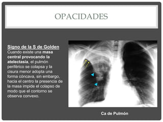 OPACIDADES
Signo de la S de Golden
Cuando existe una masa
central provocando la
atelectasia, el pulmón
periférico se colapsa y la
cisura menor adopta una
forma cóncava, sin embargo,
hacia el centro la presencia de
la masa impide el colapso de
modo que el contorno se
observa convexo.
Ca de Pulmón
 