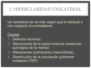 1. HIPERCLARIDAD UNILATERAL
Un hemitórax se ve más negro que lo habitual o
con respecto al contralateral.
Causas
1. Defectos técnicos
2. Alteraciones de la pared torácica (resección
quirúrgica de la mama)
3. Alteraciones pulmonares (neumotórax)
4. Disminución de la circulación pulmonar
unilateral (TEP)
 