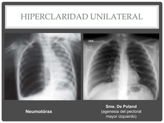 HIPERCLARIDAD UNILATERAL
Neumotórax
Sme. De Poland
(agenesia del pectoral
mayor izquierdo)
 