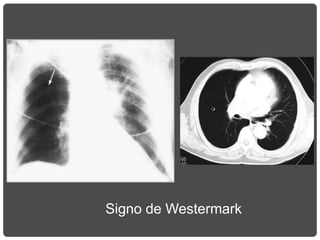 Signo de Westermark
 
