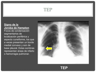 TEP
Signo de la
Joroba de Hampton
Focos de condensación
segmentarios de
localización periférica y
aspecto cuneiforme, los que
a veces presentan un borde
medial convexo y son de
base pleural. Estas sombras
representan áreas de infarto
o hemorragia pulmonar.
TEP
 
