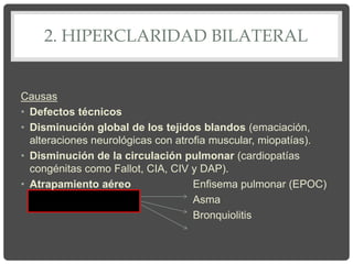 2. HIPERCLARIDAD BILATERAL
Causas
• Defectos técnicos
• Disminución global de los tejidos blandos (emaciación,
alteraciones neurológicas con atrofia muscular, miopatías).
• Disminución de la circulación pulmonar (cardiopatías
congénitas como Fallot, CIA, CIV y DAP).
• Atrapamiento aéreo Enfisema pulmonar (EPOC)
Asma
Bronquiolitis
 
