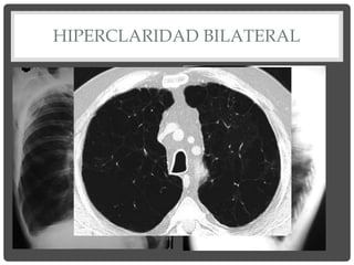 HIPERCLARIDAD BILATERAL
 