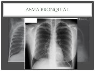 ASMA BRONQUIAL
Signos de atrapamiento aéreo
 