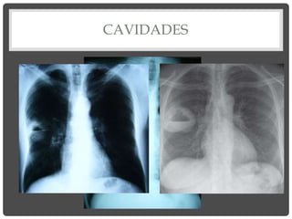 CAVIDADES
 
