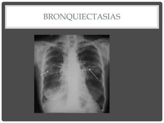 BRONQUIECTASIAS
 