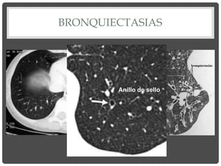BRONQUIECTASIAS
Imagen en TC
Anillo de sello
 