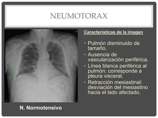 NEUMOTORAX
Características de la imagen
• Pulmón disminuido de
tamaño.
• Ausencia de
vascularización periférica.
• Línea blanca periférica al
pulmón: corresponde a
pleura visceral.
• Retracción mesiastinal:
desviación del mesiastino
hacia el lado afectado.
N. Normotensivo
 