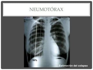 NEUMOTÓRAX
50%
Estimación del colapso
 