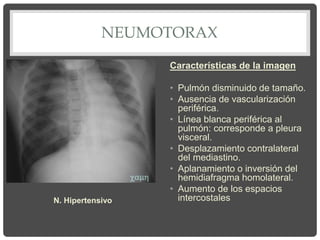 NEUMOTORAX
Características de la imagen
• Pulmón disminuido de tamaño.
• Ausencia de vascularización
periférica.
• Línea blanca periférica al
pulmón: corresponde a pleura
visceral.
• Desplazamiento contralateral
del mediastino.
• Aplanamiento o inversión del
hemidiafragma homolateral.
• Aumento de los espacios
intercostales
N. Hipertensivo
 