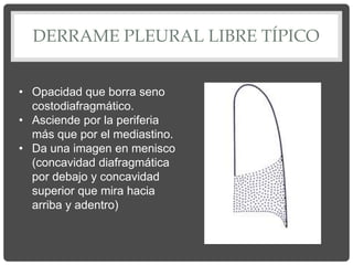 DERRAME PLEURAL LIBRE TÍPICO
• Opacidad que borra seno
costodiafragmático.
• Asciende por la periferia
más que por el mediastino.
• Da una imagen en menisco
(concavidad diafragmática
por debajo y concavidad
superior que mira hacia
arriba y adentro)
 