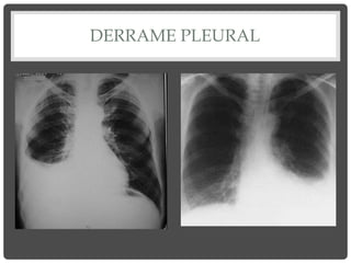 DERRAME PLEURAL
 