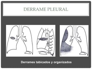 DERRAME PLEURAL
Derrames tabicados y organizados
 