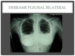 DERRAME PLEURAL BILATERAL
 
