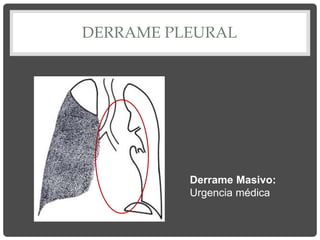 DERRAME PLEURAL
Derrame Masivo:
Urgencia médica
 
