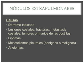NÓDULOS EXTRAPULMONARES
Causas
• Derrame tabicado
• Lesiones costales: fracturas, metastasis
costales, tumores primarios de las costillas.
• Lipomas.
• Mesoteliomas pleurales (benignos o malignos).
• Angiomas.
 