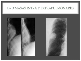 D/D MASAS INTRA Y EXTRAPULMONARES
 
