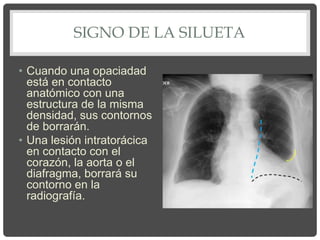 SIGNO DE LA SILUETA
• Cuando una opaciadad
está en contacto
anatómico con una
estructura de la misma
densidad, sus contornos
de borrarán.
• Una lesión intratorácica
en contacto con el
corazón, la aorta o el
diafragma, borrará su
contorno en la
radiografía.
 