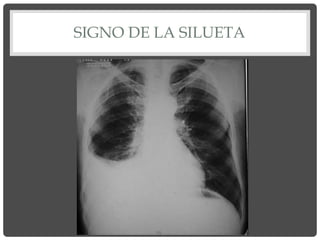 SIGNO DE LA SILUETA
 