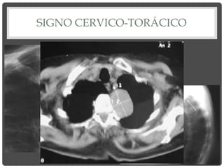SIGNO CERVICO-TORÁCICO
 