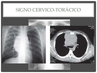 SIGNO CERVICO-TORÁCICO
 