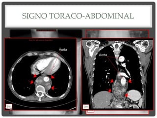 SIGNO TORACO-ABDOMINAL
 