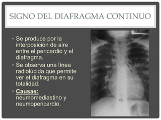 SIGNO DEL DIAFRAGMA CONTINUO
• Se produce por la
interposición de aire
entre el pericardio y el
diafragma.
• Se observa una línea
radiolúcida que permite
ver el diafragma en su
totalidad.
• Causas:
neumomediastino y
neumopericardio.
 