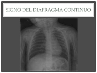 SIGNO DEL DIAFRAGMA CONTINUO
 