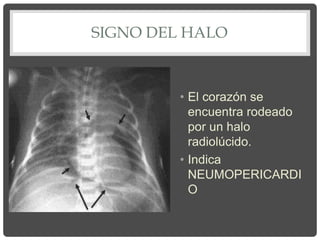 SIGNO DEL HALO
• El corazón se
encuentra rodeado
por un halo
radiolúcido.
• Indica
NEUMOPERICARDI
O
 