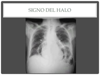 SIGNO DEL HALO
 