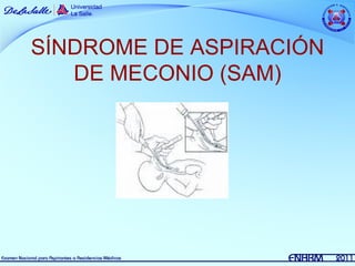 SÍNDROME DE ASPIRACIÓN
   DE MECONIO (SAM)
 