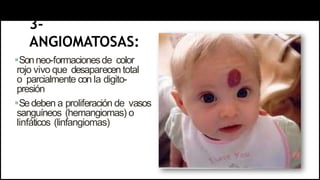 3-
ANGIOMATOSAS:
Sonneo-formacionesde color
rojo vivo que desaparecen total
o parcialmente con la digito-
presión
Sedeben a proliferación de vasos
sanguíneos (hemangiomas) o
linfáticos (linfangiomas)
 