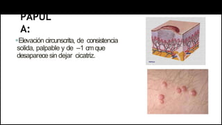 PÁPUL
A:
Elevación circunscrita, de consistencia
solida, palpable y de –1 cmque
desaparece sin dejar cicatriz.
 