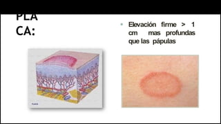 PLA
CA:
 Elevación firme > 1
cm mas profundas
que las pápulas
 