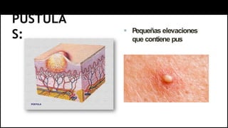 PÚSTULA
S:  Pequeñas elevaciones
que contiene pus
 