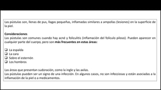 Las pústulas son, llenas de pus, llagas pequeñas, inflamadas similares a ampollas (lesiones) en la superficie de
la piel.
Consideraciones
Las pústulas son comunes cuando hay acné y foliculitis (inflamación del folículo piloso). Pueden aparecer en
cualquier parte del cuerpo, pero son más frecuentes en estas áreas:
 La espalda
 La cara
 Sobre el esternón
 Los hombros
Las áreas que presentan sudoración, como la ingle y las axilas.
Las pústulas pueden ser un signo de una infección. En algunos casos, no son infecciosas y están asociadas a la
inflamación de la piel o a medicamentos.
 