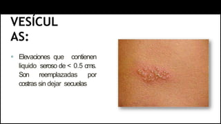 VESÍCUL
AS:
 Elevaciones que contienen
liquido seroso de < 0.5 cms.
Son reemplazadas por
costras sin dejar secuelas
 