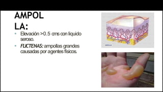 AMPOL
LA:
 Elevación >0.5 cmscon liquido
seroso.
 FLICTENAS:ampollas grandes
causadas por agentesfísicos.
 