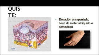QUIS
TE:
 Elevación encapsulada,
llena de material liquido o
semisólido
 