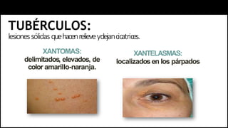 TUBÉRCULOS:
lesionessólidasquehacenrelieveydejancicatrices.
XANTOMAS:
delimitados, elevados, de
color amarillo-naranja.
XANTELASMAS:
localizadosen los párpados
 