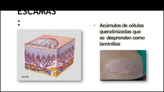 ESCAMAS
:  Acúmulos de células
queratinizadas que
se desprenden como
laminillas
 