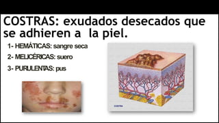 COSTRAS: exudados desecados que
se adhieren a la piel.
1- HEMÁTICAS: sangre seca
2- MELICÉRICAS: suero
3- PURULENT
AS:pus
 