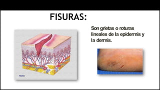 FISURAS:
Songrietas o roturas
lineales de la epidermis y
la dermis.
 