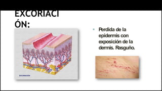 EXCORIACI
ÓN:  Perdida de la
epidermis con
exposición de la
dermis. Rasguño.
 